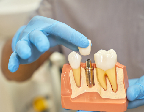 Как проходит заживление после имплантации зубов
